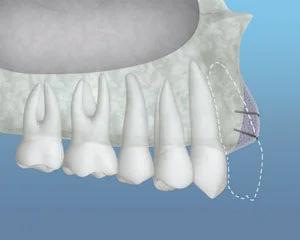 Graft Material Placed Img