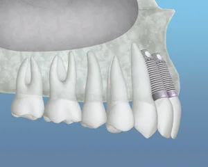Implants Placed Img