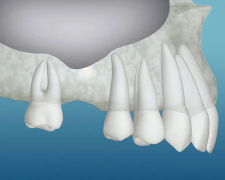 Inadequate Bone Img