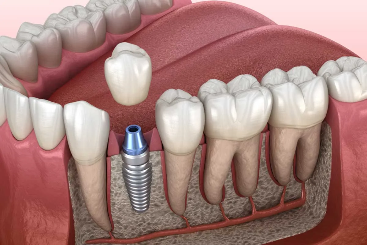 Individual Implants Img