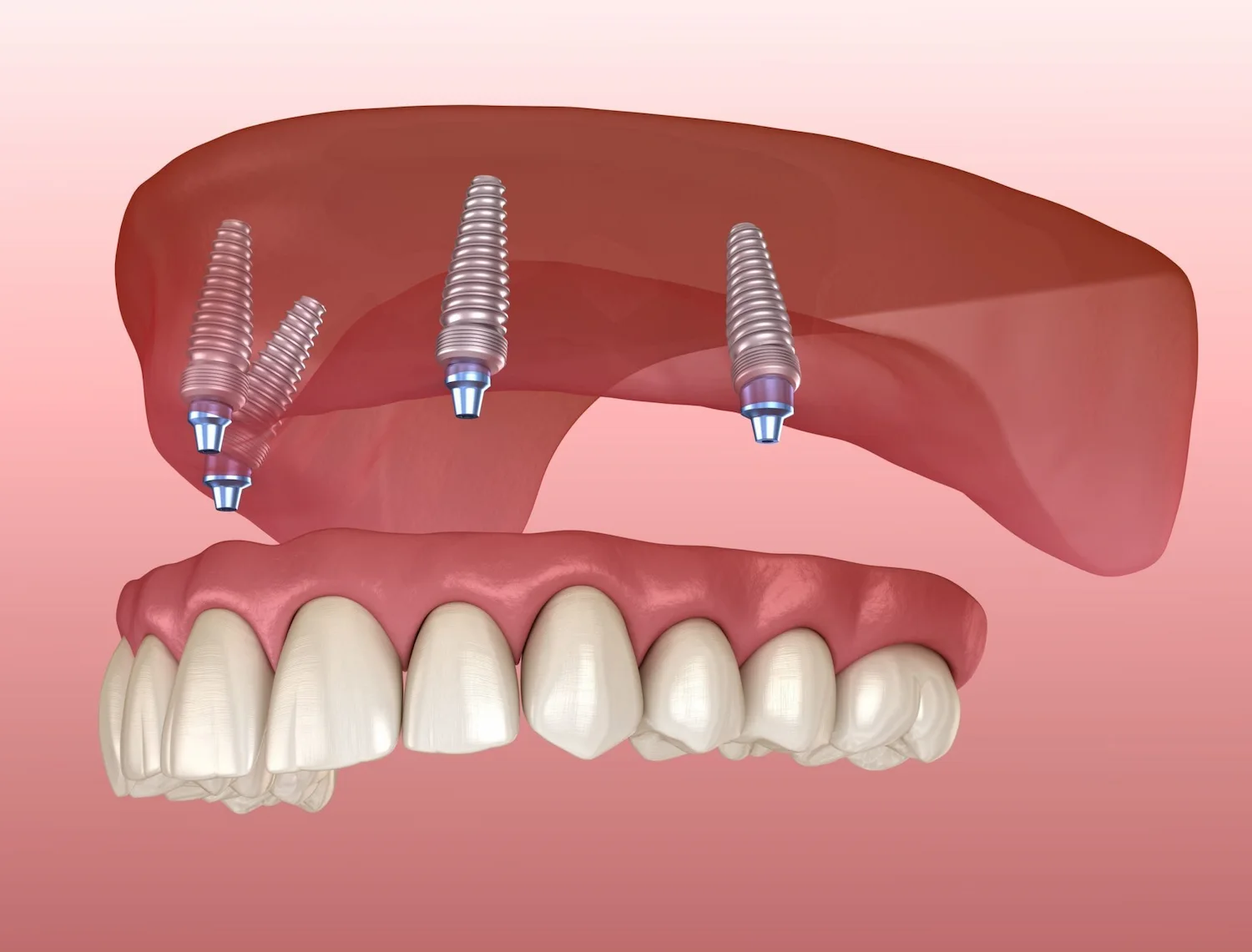 Individual Upper Implants Img