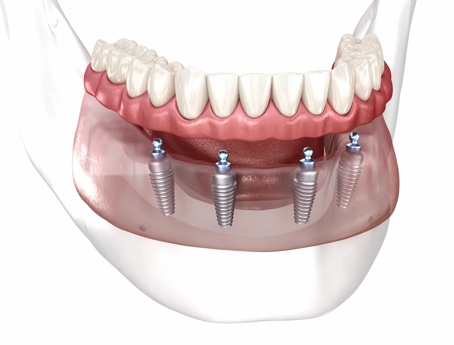 Missing All Upper Or Lower Teeth Img