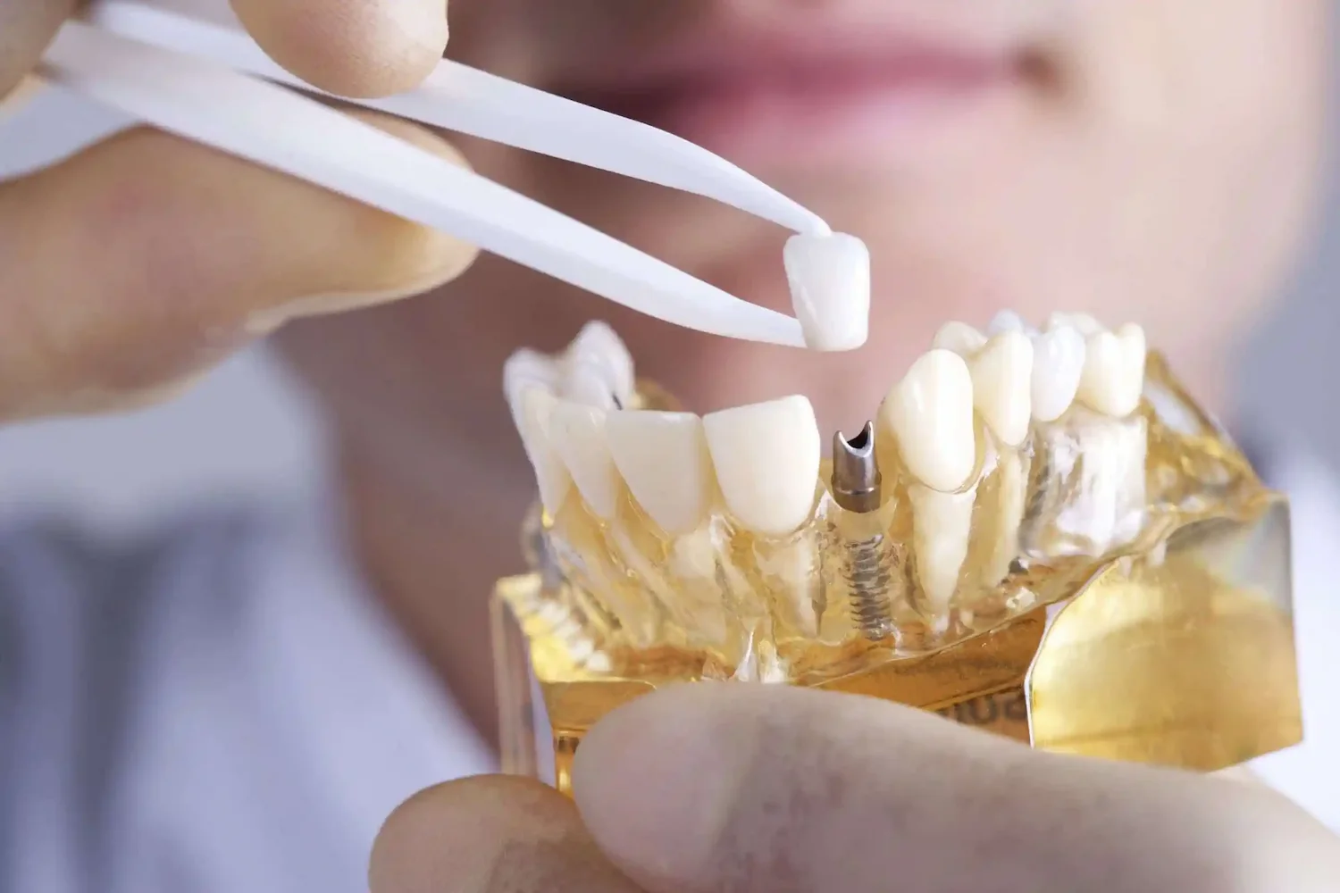 Replacing Missing Teeth Img