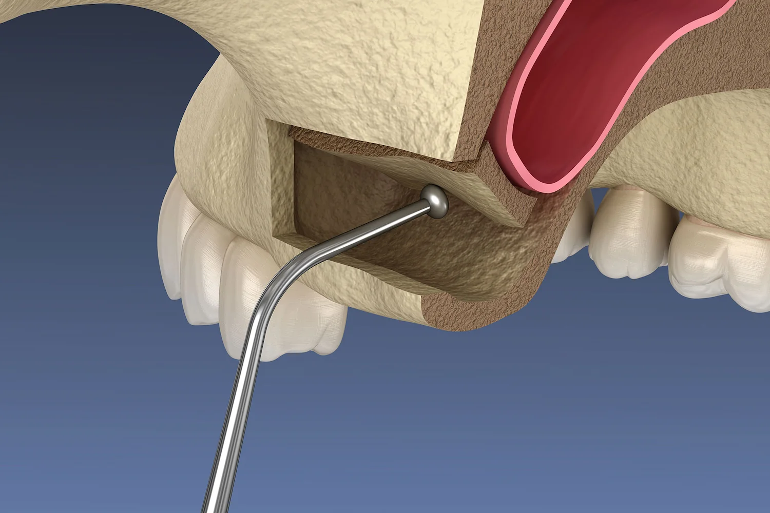 Sinus Grafting Img