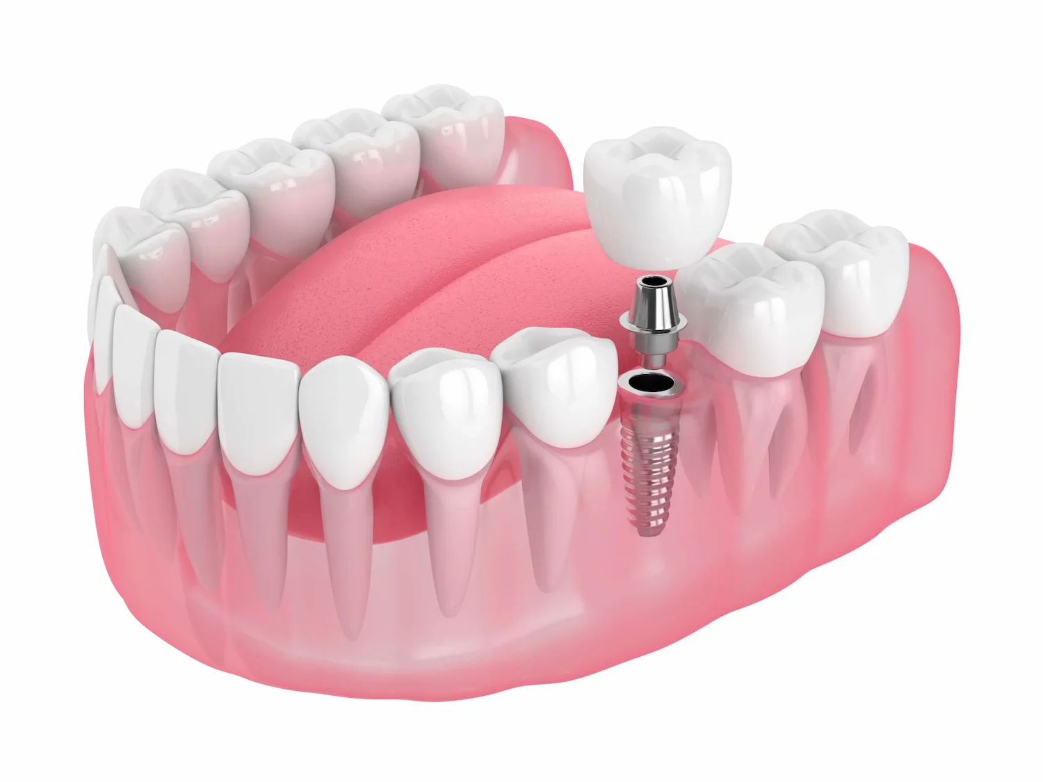 Dental Implants Img 2