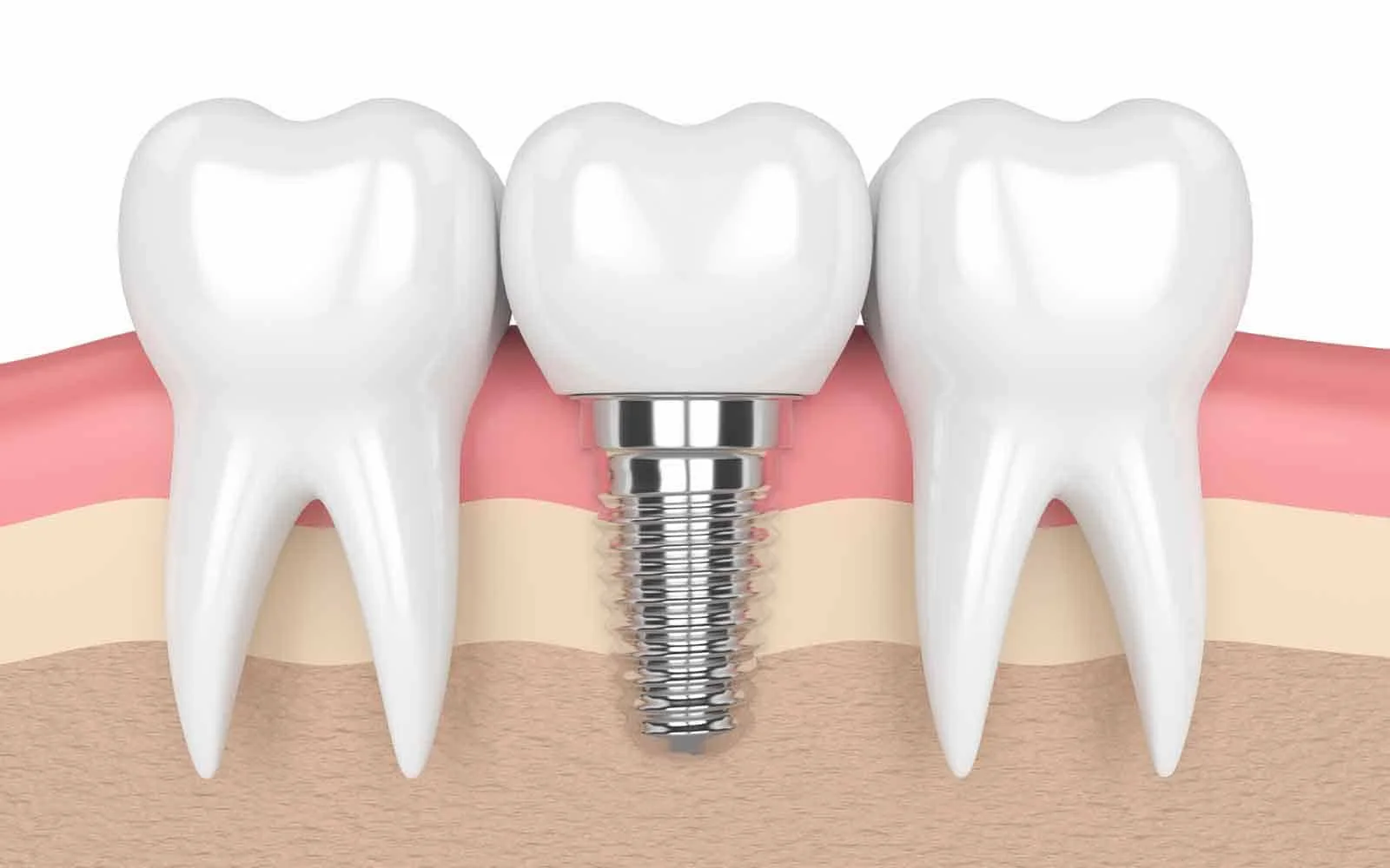 Dental Implants Img