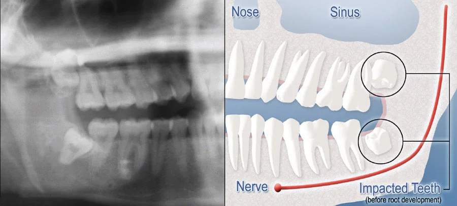 Impacted Tooth Img