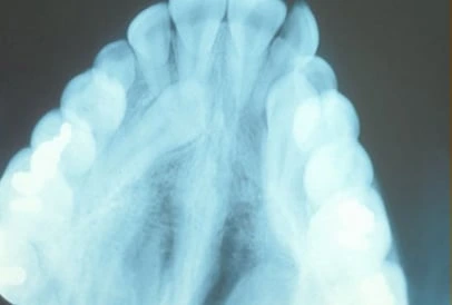 Impacted Tooth1 Full