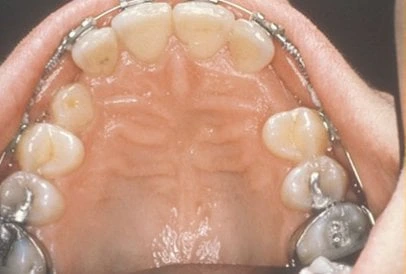 Impacted Tooth2 Full