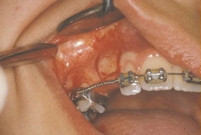 Impacted Tooth3 Full