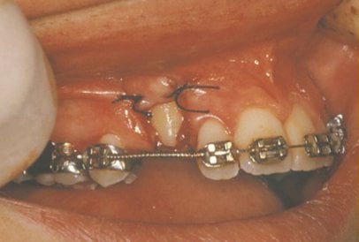 Impacted Tooth4 Full