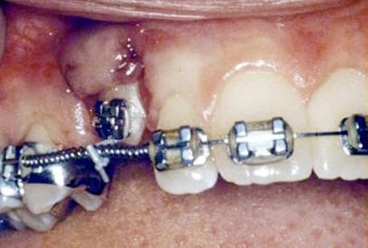 Impacted Tooth5 Full