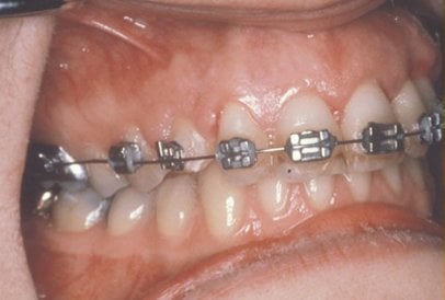 Impacted Tooth6 Full